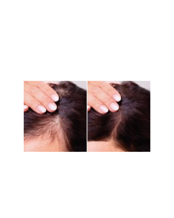 ANTI HAIR LOSS